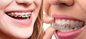 How to Choose the Best Orthodontist in Baner for Braces & Aligners (Complete Guide)