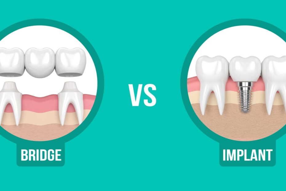 Dental Implants vs Bridges